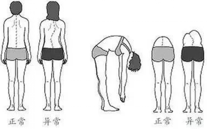 中老年人脊柱側彎自檢，及時了解脊柱健康