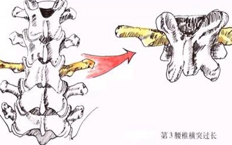 你平時有腰痛的癥狀嗎？來了解下什么是L3橫突綜合征