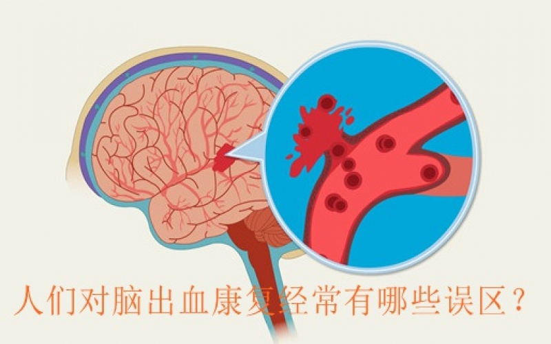 人們對腦出血康復經常有哪些誤區？