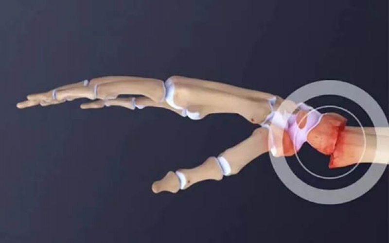浙二康復科普：橈骨遠端骨折介紹及圍手術期康復鍛煉方法