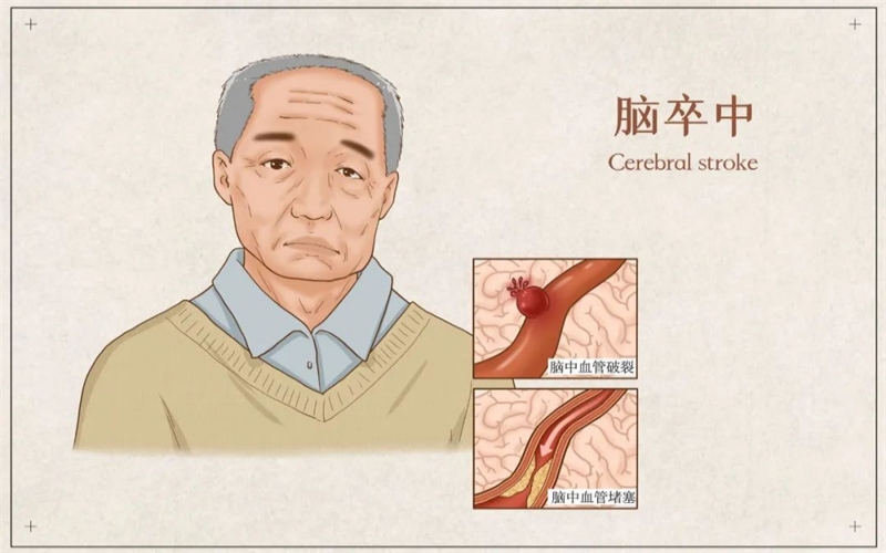 老年人需要警惕腦血管病的高發季節